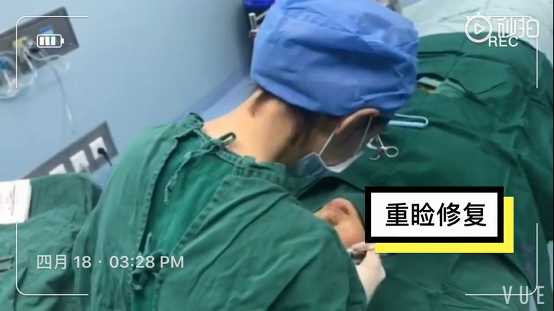 上海美莱双眼皮手术过程