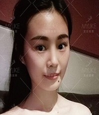 美莱案例李火火对比图后