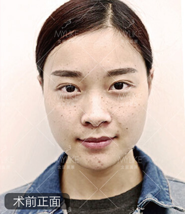 杨梅激光祛斑美肤+北京美莱皮秒祛斑案例
