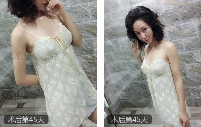 悦儿小姐姐 5g超动感丰胸 北京美莱_美莱整形医院品牌