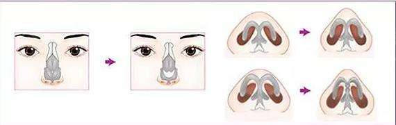 鼻头缩小术整形是怎样的