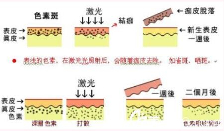 昆明华美美莱美容医院俞满昌激光祛斑