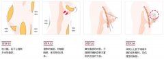 广州自体脂肪丰胸效果好不好呢