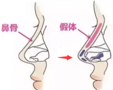 深圳假体隆鼻后要多久才能消肿