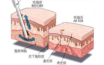 广州吸脂瘦脸要多少钱