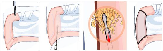 深圳去哪里做吸脂瘦腰效果比较好