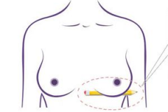 女性乳房下垂应该怎么办