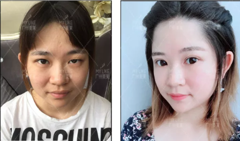 广州做割双眼皮手术哪种方法好呢