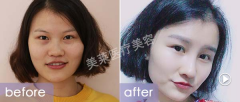 广州做割双眼皮手术哪种方法好呢
