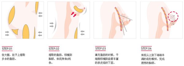 自体脂肪丰胸