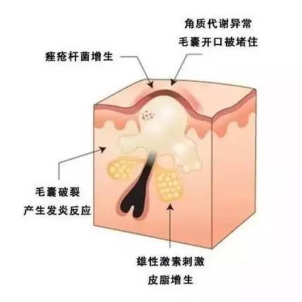 闭口和粉刺有什么区别，怎么祛除