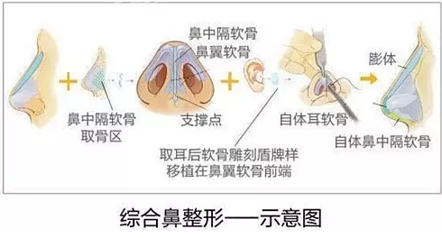 深圳美莱鼻综合整形有哪些呢