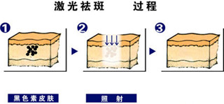 丽江日晒斑怎么祛除价格多少