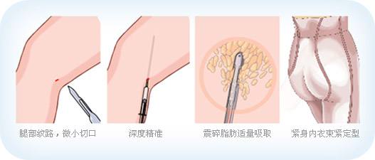 吸脂瘦腿手术后多长时间可以恢复呢