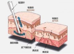 佛山美莱手臂吸脂有副作用吗