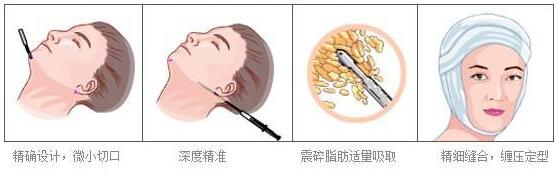 面部吸脂术后脸部出现的硬块怎么消除呢