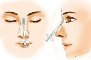 玻尿酸隆鼻副作用有哪些