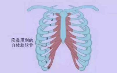 自体软骨隆鼻的好处有哪些呢