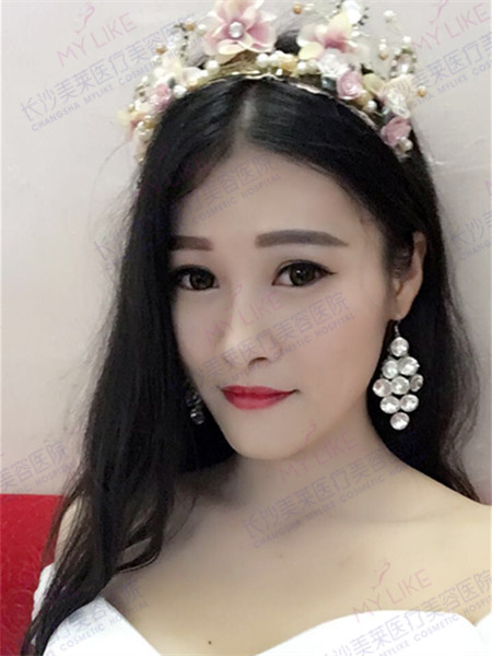 美莱案例娜娜对比图后