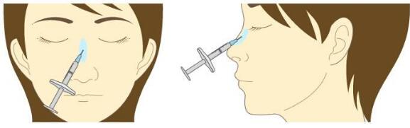 贵阳注射隆鼻的优势有哪些呢