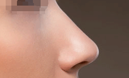 假体隆鼻会有后遗症吗