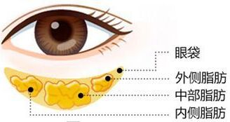 祛眼袋