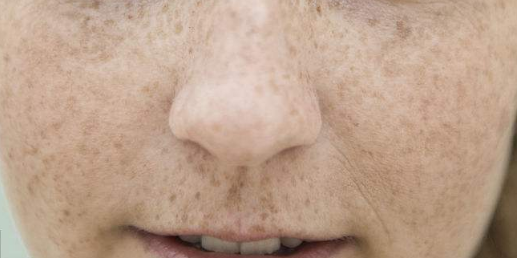 女性脸上的雀斑消除的方法