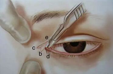 开眼角术后疤痕增生多长时间会消失