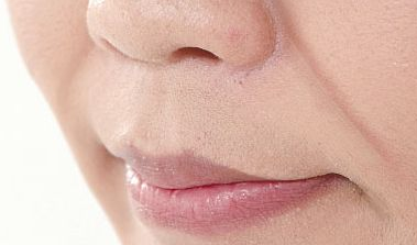 广州有哪些好方法可以改善鼻唇沟呢