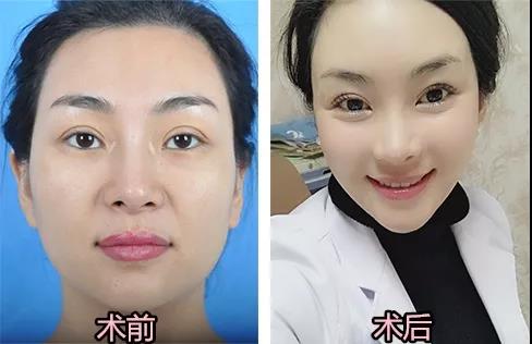 广州有什么好方法可以给脸部凹陷进行填充呢