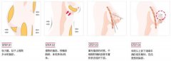 广州做自体脂肪隆胸术后会不会出现胸部下垂的现象呢