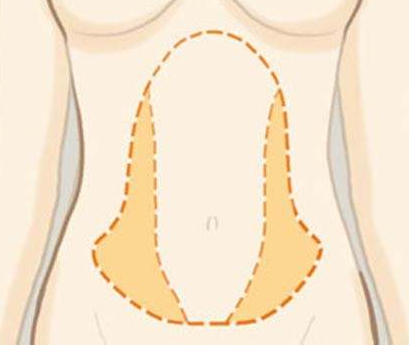 腰腹部吸脂后会不会有后遗症