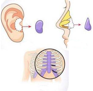 自体软骨隆鼻的危害有哪些