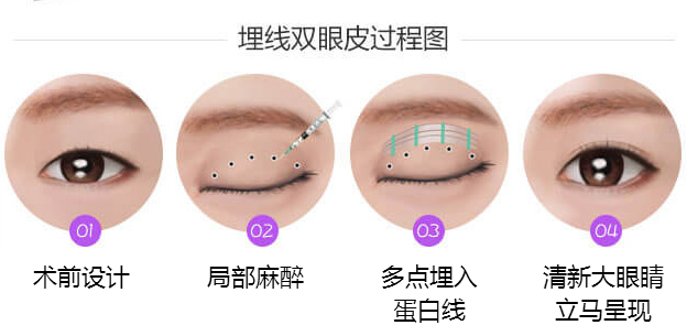 衡阳哪里做埋线双眼皮比较好