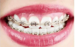 衡阳成年人牙齿矫正一般需要多长时间