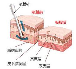 抽脂减肥会不会有后遗症