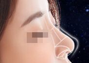 什么是硅胶隆鼻