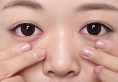 北京做眼部整形祛眼袋术后要多久才可以恢复呢