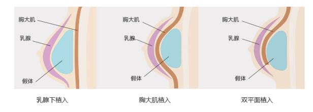 自体脂肪隆胸