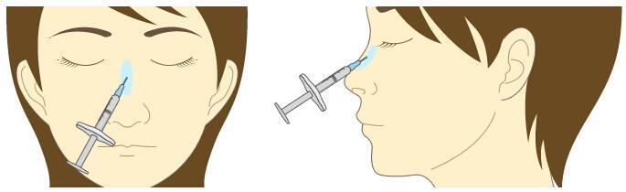 注射玻尿酸隆鼻