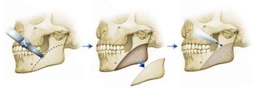 福州下颌角整形手术是怎样的