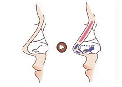 福州假体隆鼻失败有哪些因素