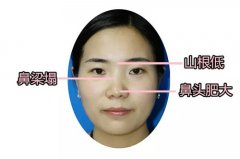 福州假体隆鼻手术需要多少钱呢