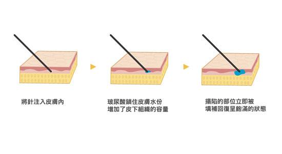 成都做玻尿酸除皱效果能维持多长时间