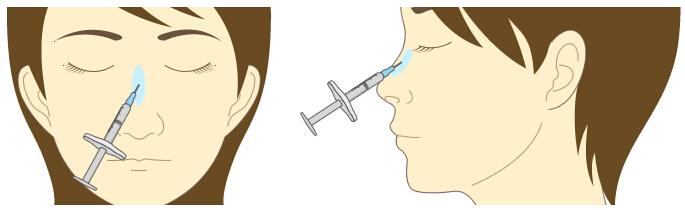 长沙哪些鼻型适合注射玻尿酸