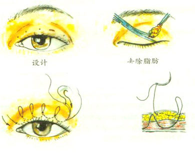 上海做双眼皮整形能保持多久