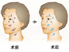 泉州做电波拉皮能维持多长时间