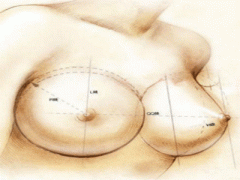 上海乳房下垂矫正有哪些方法