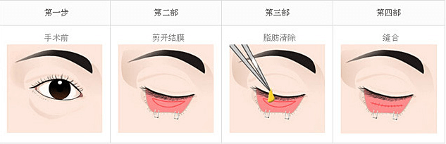 去眼袋