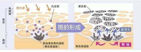 黄褐斑
